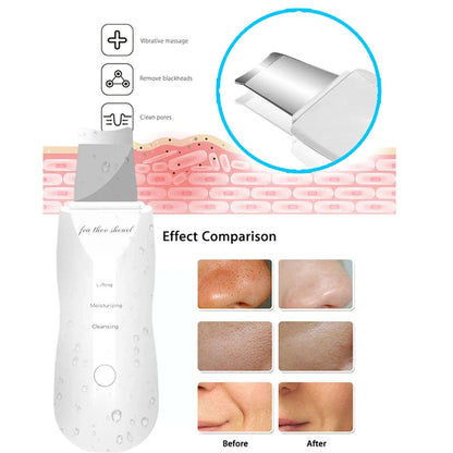 Ultrasonic Skin Scrubberskin Peeling Machine Blackhead Remove