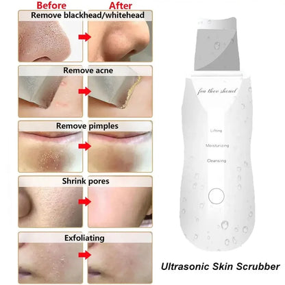 Ultrasonic Skin Scrubberskin Peeling Machine Blackhead Remove